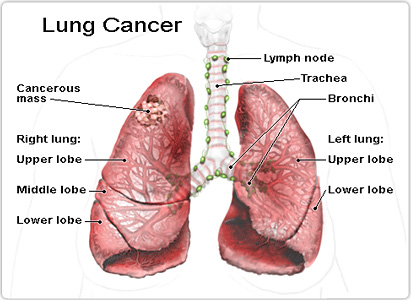 肺癌症状