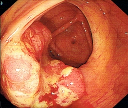 大肠内壁的肿瘤
